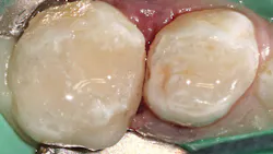 Figure 8: Immediate postoperative mesial-occlusal restoration with Composi-Tight 3D XR system Figure 8: Immediate postoperative mesial-occlusal restoration with Composi-Tight 3D XR system