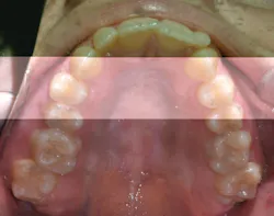 Figure 4: Patient presents with improper arch width: 27 mm transverse measurement (TM) Figure 4: Patient presents with improper arch width: 27 mm transverse measurement (TM)