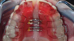 Figure 6: Patient achieves significant maxillary growth in eight months with the use of accelerated orthodontics (VPro+ device) Figure 6: Patient achieves significant maxillary growth in eight months with the use of accelerated orthodontics (VPro+ device)