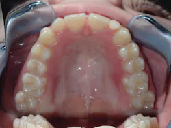 Figure 7: Patient achieves 7 mm of development resulting in a 34 mm TM and changes in palatal vault anatomy Figure 7: Patient achieves 7 mm of development resulting in a 34 mm TM and changes in palatal vault anatomy