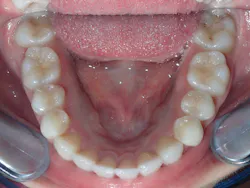 Figure 10: The tongue has an increased amount of oral cavity volume Figure 10: The tongue has an increased amount of oral cavity volume