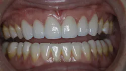 Final restorations Final restorations