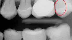 Figure 1: Bitewing radiograph made with a state-of-the-art CMOS sensor shows only a few suspect areas of caries. Figure 1: Bitewing radiograph made with a state-of-the-art CMOS sensor shows only a few suspect areas of caries.