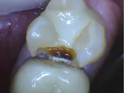Figure 2: The actual extent of the carious lesion in the mesial of the second molar, not identifiable on the radiograph, clearly highlights one of the major problems with current CMOS sensors. Figure 2: The actual extent of the carious lesion in the mesial of the second molar, not identifiable on the radiograph, clearly highlights one of the major problems with current CMOS sensors.