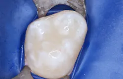 Figure 4: The sealant in this extracted tooth example was placed with the technique described in this article. Such sealants will not fail! Figure 4: The sealant in this extracted tooth example was placed with the technique described in this article. Such sealants will not fail!
