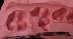 Figure 4: After preparation refinement, an alginate impression is done Figure 4: After preparation refinement, an alginate impression is done