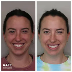 Botox and fillers for gummy smile treatment Botox and fillers for gummy smile treatment