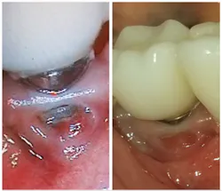 Figure 1: Failing implant saved by the use of chlorine dioxide Figure 1: Failing implant saved by the use of chlorine dioxide