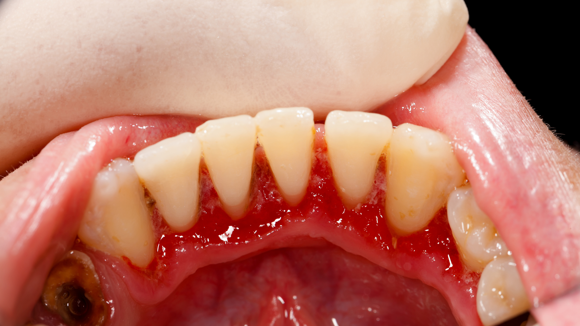 Gum Disease