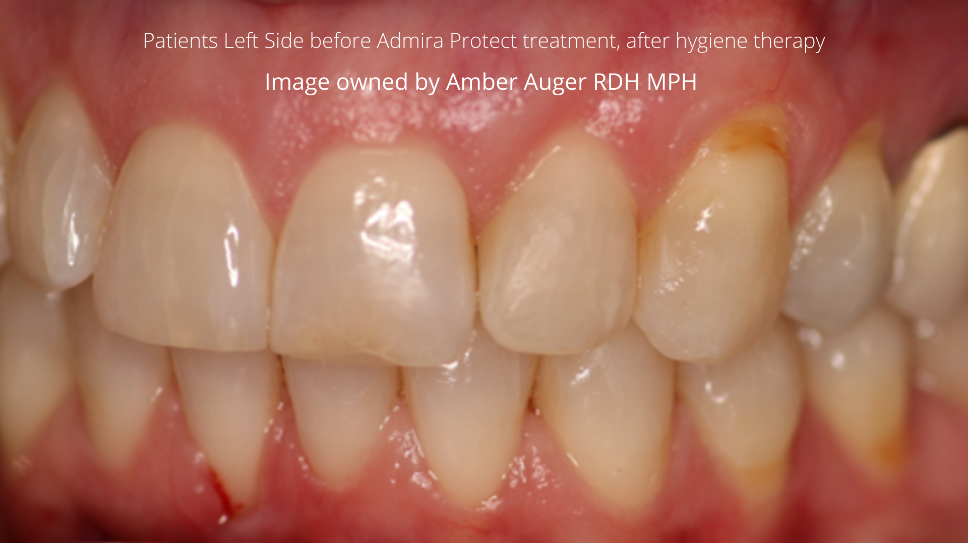 Figure 1: Patient&rsquo;s left side before Admira Protect treatment and after hygiene therapy.