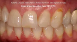 Figure 1: Patient’s left side before Admira Protect treatment and after hygiene therapy. Figure 1: Patient’s left side before Admira Protect treatment and after hygiene therapy.