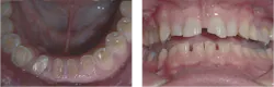 Figure 1: Among the most frequently identified reasons for implant failure is occlusion. These images show grinding and clenching bruxism for which implant-supported prostheses would require meticulous planning and procedures for success. Figure 1: Among the most frequently identified reasons for implant failure is occlusion. These images show grinding and clenching bruxism for which implant-supported prostheses would require meticulous planning and procedures for success.