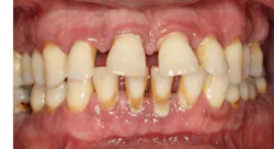 Figure 5: If some of these periodontally diseased teeth needed to be extracted, conventional dentistry would probably be better since the organisms causing the periodontal disease and remaining in the mouth have high potential to stimulate peri-implantitis. Figure 5: If some of these periodontally diseased teeth needed to be extracted, conventional dentistry would probably be better since the organisms causing the periodontal disease and remaining in the mouth have high potential to stimulate peri-implantitis.