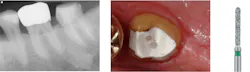 Figure 3: Roughening the external axial walls of the tooth prep with a coarse diamond at the cementation appointment allows the cement to become a luting procedure for this short, potentially weak prep, and reduces the chance of the crown coming off. Figure 3: Roughening the external axial walls of the tooth prep with a coarse diamond at the cementation appointment allows the cement to become a luting procedure for this short, potentially weak prep, and reduces the chance of the crown coming off.