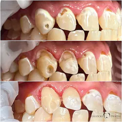 Figure 2: Nos. 6 and 7 are facial carious lesions. Caries were removed with the Solea laser at 40% power, 9 mL mist, medium air, and 1.25 mm spot size. The gingivectomy was performed by reducing the power to 20%, resulting in zero to minimal bleeding. The teeth were restored with Ivoclar Adhese and Tetric Prime Flow. Photos were taken before, during, and immediately after completion. Figure 2: Nos. 6 and 7 are facial carious lesions. Caries were removed with the Solea laser at 40% power, 9 mL mist, medium air, and 1.25 mm spot size. The gingivectomy was performed by reducing the power to 20%, resulting in zero to minimal bleeding. The teeth were restored with Ivoclar Adhese and Tetric Prime Flow. Photos were taken before, during, and immediately after completion.