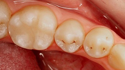 Figure 1: Pit and fissure staining prevalent on nos. 20 and 21.