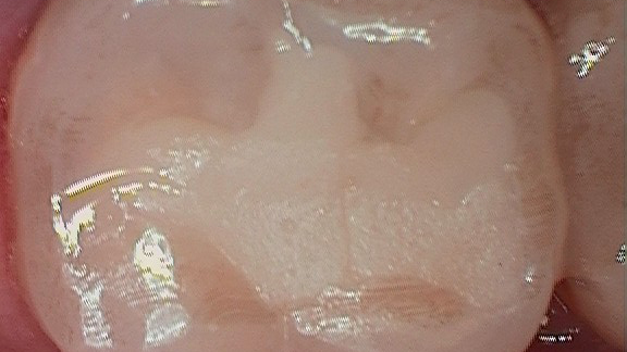 Fig 6 36 Mo Po Occlusal 63b46a8151d07