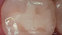 Fig 6 36 Mo Po Occlusal 63b46a8151d07 Fig 6 36 Mo Po Occlusal 63b46a8151d07