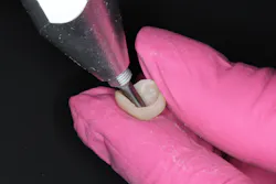 Figure 3: Air abrasion of restorations at 30-50 microns, set at low pressure 30 psi Figure 3: Air abrasion of restorations at 30-50 microns, set at low pressure 30 psi