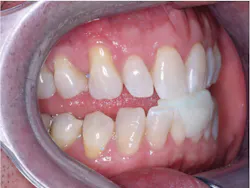 Figure 1: This patient is ready to have an interocclusal record made about 70% forward in incisal guidance for a sleep appliance (dreamTAP). Figure 1: This patient is ready to have an interocclusal record made about 70% forward in incisal guidance for a sleep appliance (dreamTAP).