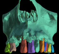 Figure 1: AI-driven bone and teeth segmentation in implant planning software Figure 1: AI-driven bone and teeth segmentation in implant planning software