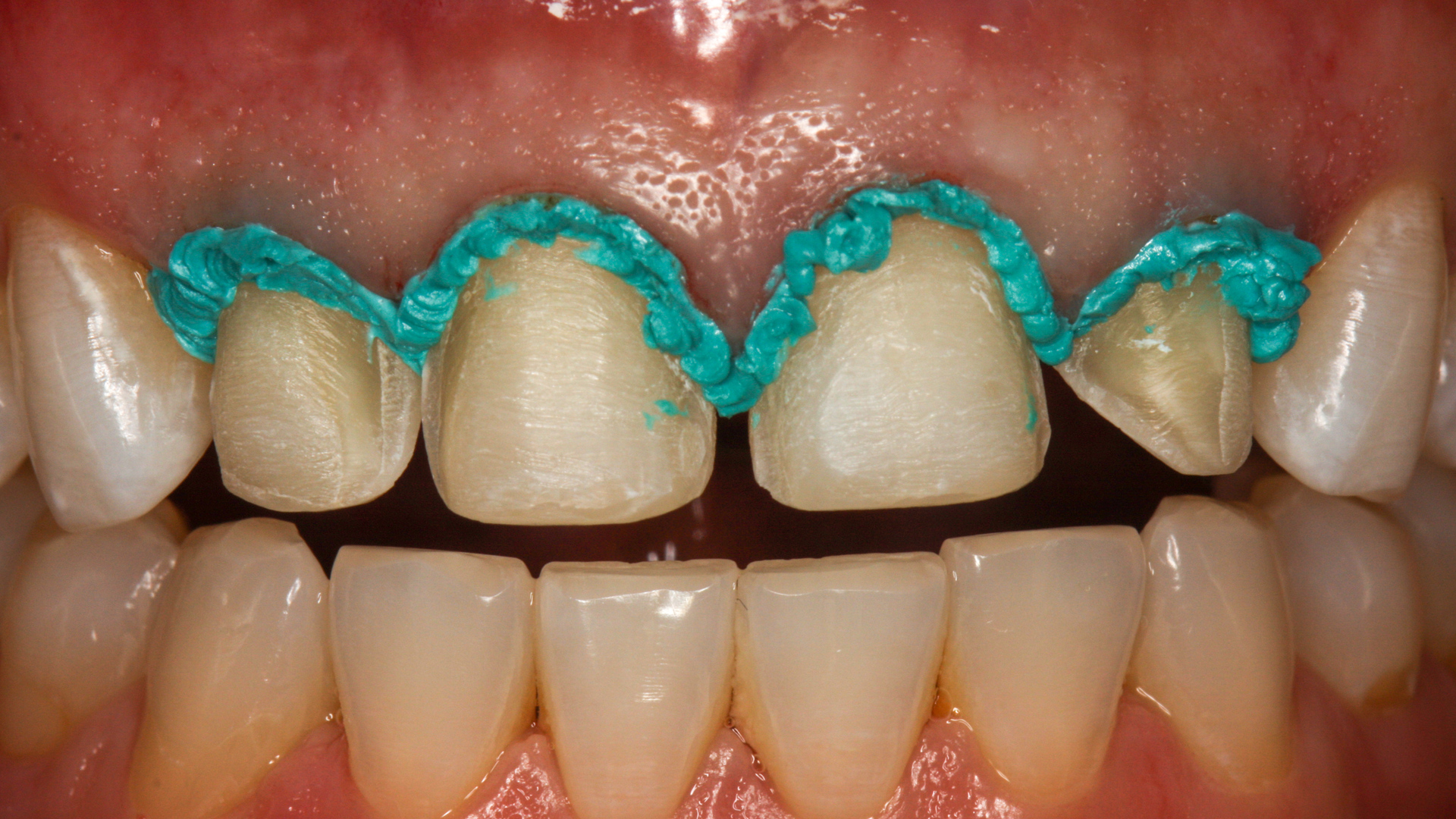 Voco Retraction Paste