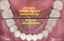 Figure 5: This patient received internally stained 3Y zirconia at the presintered stage on the molars and lithium disilicate on the remainder of the teeth. I doubt you can tell the difference. There is no stain or glaze on any of the crowns. Both 3Y zirconia and lithium disilicate wear like enamel. Glaze wears opposing tooth structure of some restorative materials (Clinicians Report Foundation TRAC in vivo research). Figure 5: This patient received internally stained 3Y zirconia at the presintered stage on the molars and lithium disilicate on the remainder of the teeth. I doubt you can tell the difference. There is no stain or glaze on any of the crowns. Both 3Y zirconia and lithium disilicate wear like enamel. Glaze wears opposing tooth structure of some restorative materials (Clinicians Report Foundation TRAC in vivo research).