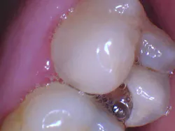 figure_1a_preop_io figure_1a_preop_io