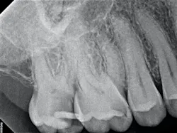 Figure 1: From top to bottom: preop IO, bitewing, and periapical x-ray Figure 1: From top to bottom: preop IO, bitewing, and periapical x-ray