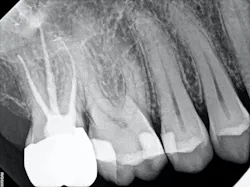 Figure 4: From top to bottom: Crown delivery bitewing after fillings, crown delivery bitewing before fillings, final periapical x-ray Figure 4: From top to bottom: Crown delivery bitewing after fillings, crown delivery bitewing before fillings, final periapical x-ray