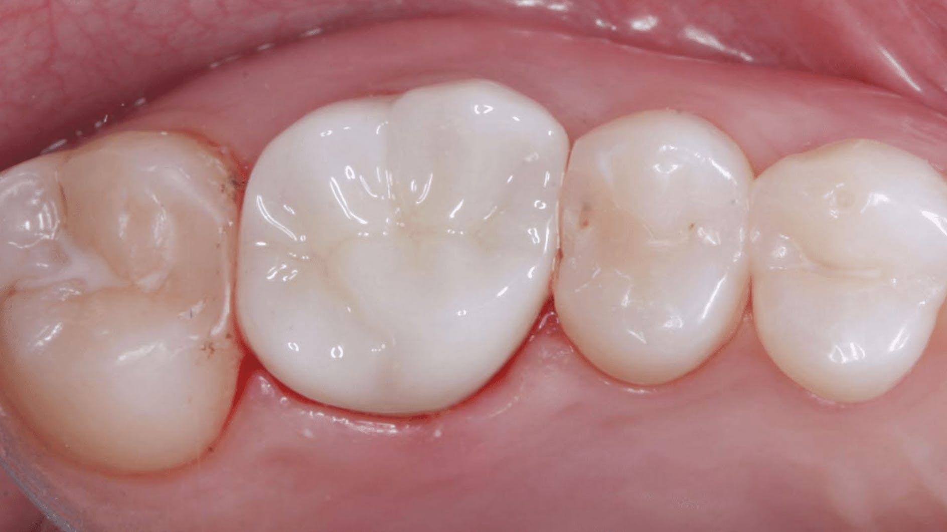 zirconia-color-mismatch