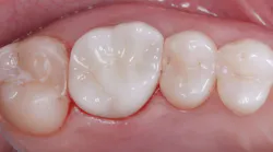 zirconia-color-mismatch zirconia-color-mismatch