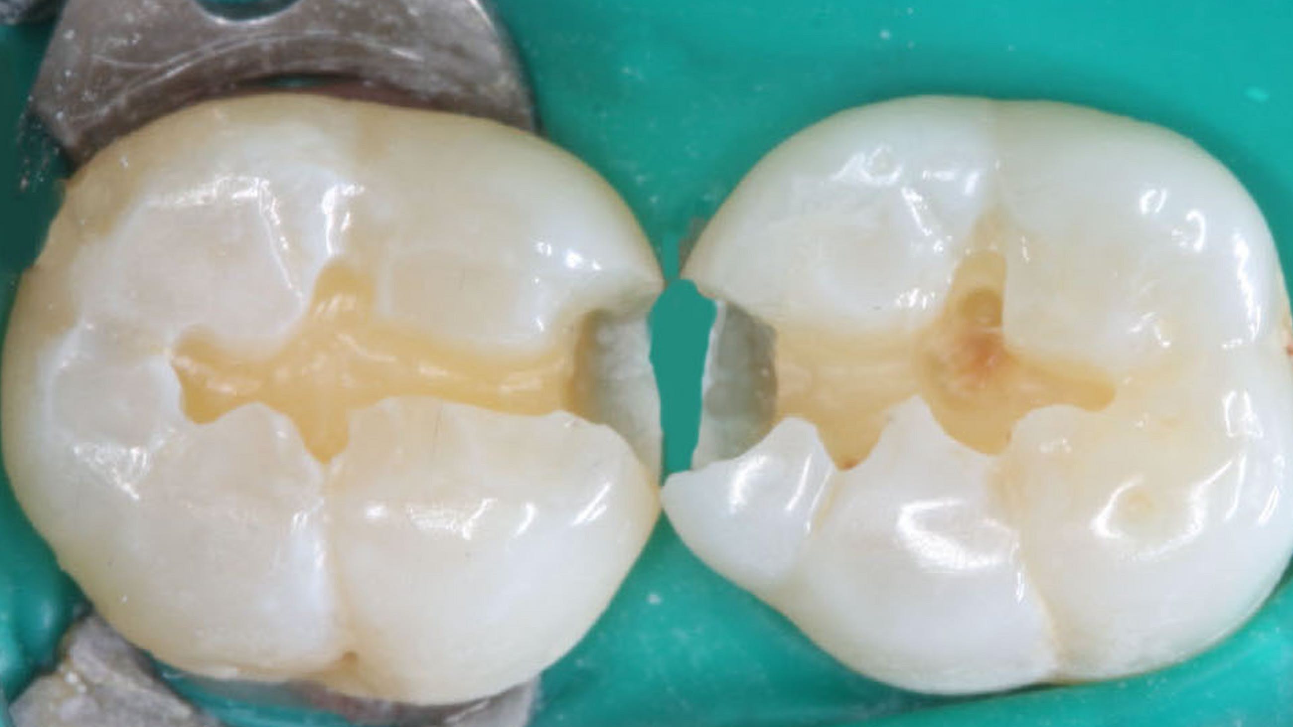 optimum-retention-dental-restorations