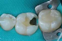 Figure 8a: Caries removal on tooth no. 19. Note the cavitated caries lesion on the mesial surface of tooth no. 18. Figure 8a: Caries removal on tooth no. 19. Note the cavitated caries lesion on the mesial surface of tooth no. 18.