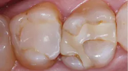 recurrent-caries recurrent-caries