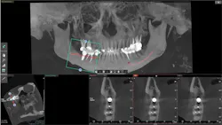 Figure 2: Cone beam images are one of the most valuable methods to educate patients about implant treatment and other dental issues. Figure 2: Cone beam images are one of the most valuable methods to educate patients about implant treatment and other dental issues.