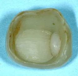 Figure 1: This is a resin-cemented crown in a long-term Clinicians Report Foundation in vivo study that came off in service, showing the leakage after only a few months in the mouth. Figure 1: This is a resin-cemented crown in a long-term Clinicians Report Foundation in vivo study that came off in service, showing the leakage after only a few months in the mouth.