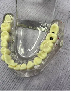 Figure 6: Final restoration Figure 6: Final restoration