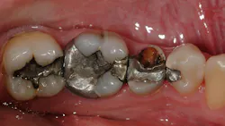 Figure 2: A second premolar potentially needing to be extracted could be replaced with one implant or a three-unit fixed prosthesis for about the same cost since the teeth on both sides of the potential edentulous space need restoration. Figure 2: A second premolar potentially needing to be extracted could be replaced with one implant or a three-unit fixed prosthesis for about the same cost since the teeth on both sides of the potential edentulous space need restoration.