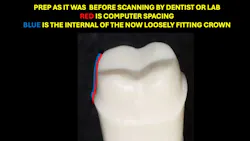 Figure 1: Computer spacing on crown tooth preparations causes several challenges. Because of significant spacing, some preps need to be cut deeper to accommodate the spacing. Figure 1: Computer spacing on crown tooth preparations causes several challenges. Because of significant spacing, some preps need to be cut deeper to accommodate the spacing.