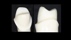 Figure 2: Because of the spacing labs are now placing on the entire surfaces of virtual preps, the intaglio surfaces of the crowns are smooth and the crowns seat easily. However, the margins are open the amount the lab tech spaced the die. This spacing causes the thickness of the crown material to be thinner and the prep to be respectively deeper. Use cariostatic cement-RMGI or conventional glass ionomer. Figure 2: Because of the spacing labs are now placing on the entire surfaces of virtual preps, the intaglio surfaces of the crowns are smooth and the crowns seat easily. However, the margins are open the amount the lab tech spaced the die. This spacing causes the thickness of the crown material to be thinner and the prep to be respectively deeper. Use cariostatic cement-RMGI or conventional glass ionomer.