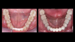 Figure 3: The left image shows early zirconia restorations with stain and glaze placed on them that will soon wear off. The right image shows current polished, internality stained zirconia (molars) with lithium disilicate crowns on the premolars. Figure 3: The left image shows early zirconia restorations with stain and glaze placed on them that will soon wear off. The right image shows current polished, internality stained zirconia (molars) with lithium disilicate crowns on the premolars.