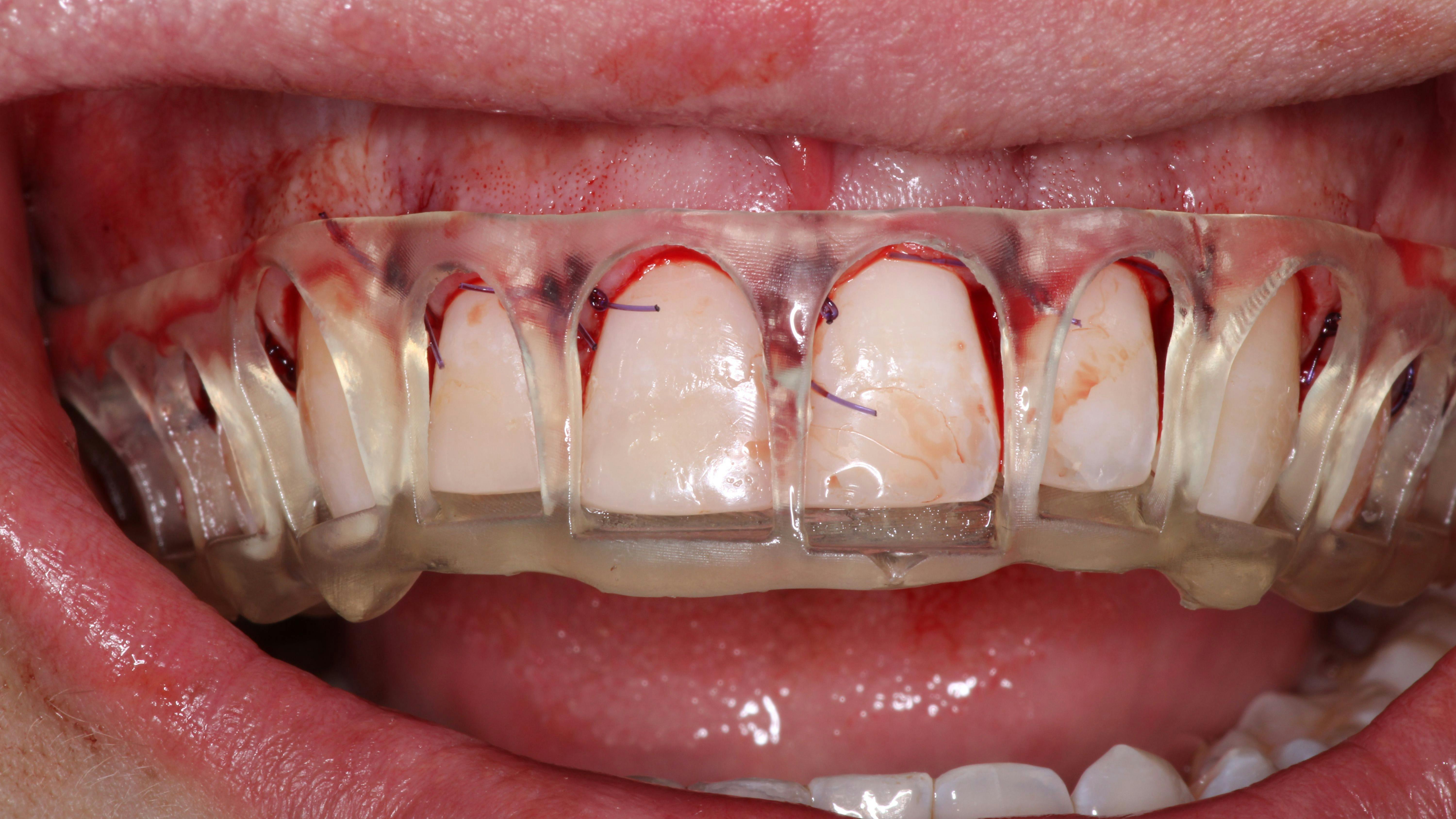 cosmetic dentistry crown lengthening