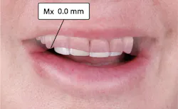 Figure 4: Superimposed smile and repose photos showing canine cusp tip coinciding with edge of upper lip Figure 4: Superimposed smile and repose photos showing canine cusp tip coinciding with edge of upper lip