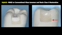 dental restoration dental restoration