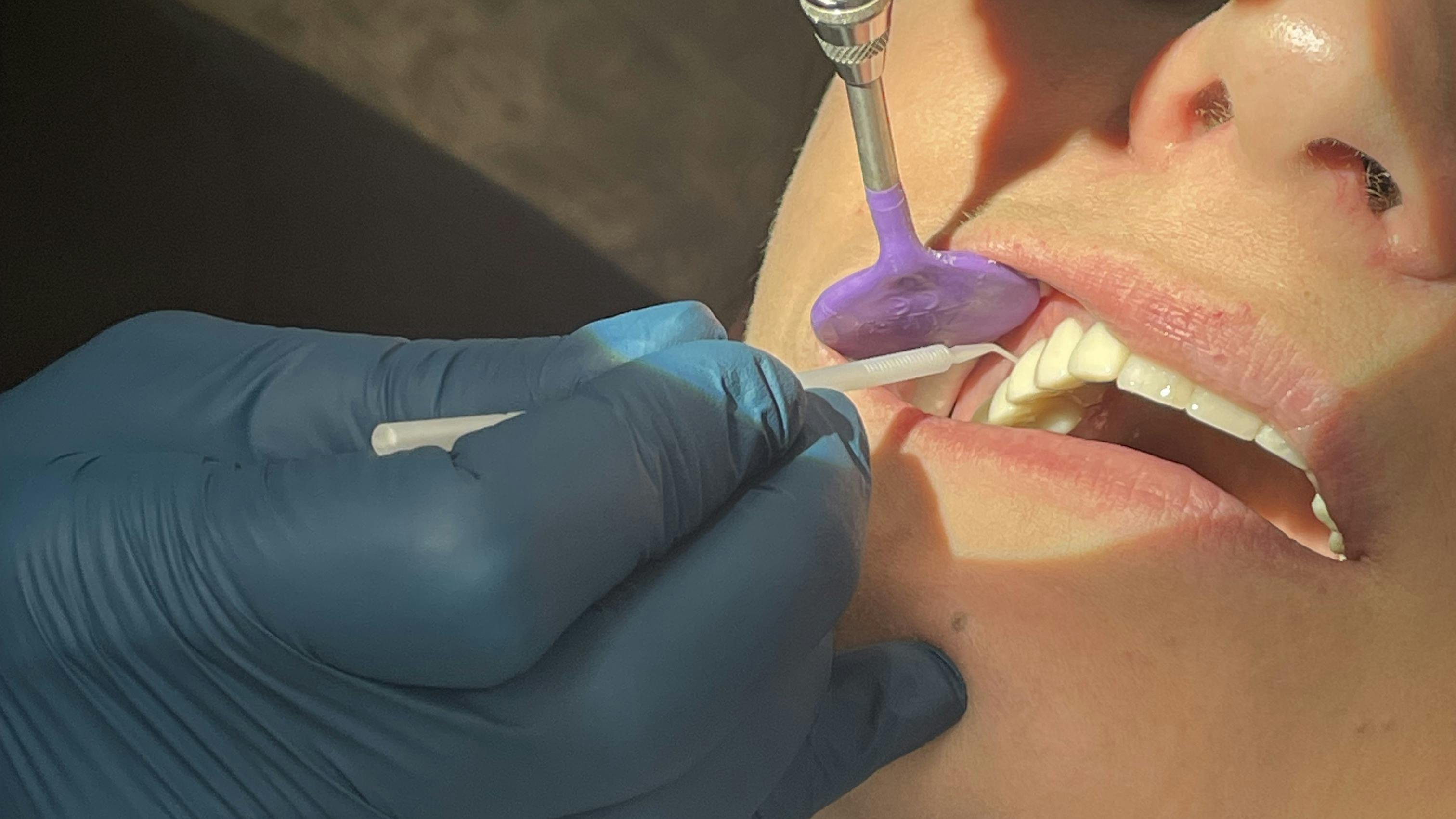 placing silver diamine fluoride on a dental patient