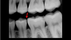 radiograph of teeth radiograph of teeth