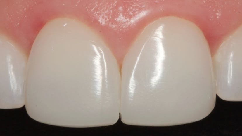 After Post-Op Direct Veneers using OMNICHROMA (Tokuyama Dental America)