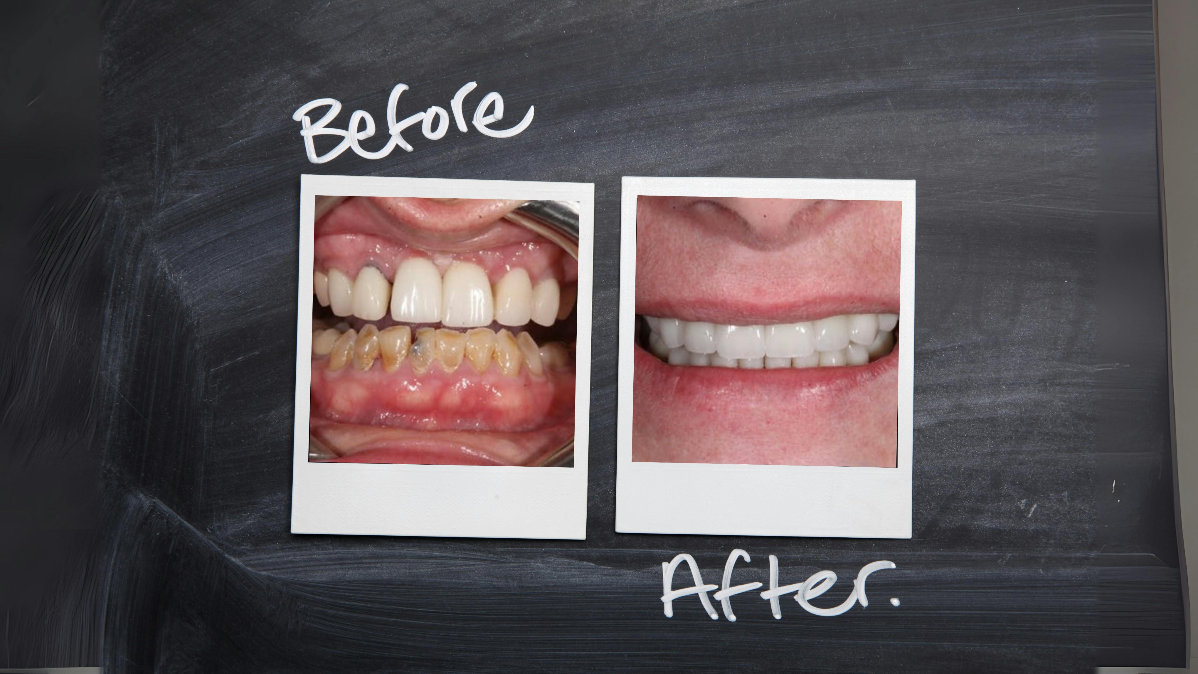 Two polaroid photos showing a dental case before and after treatment