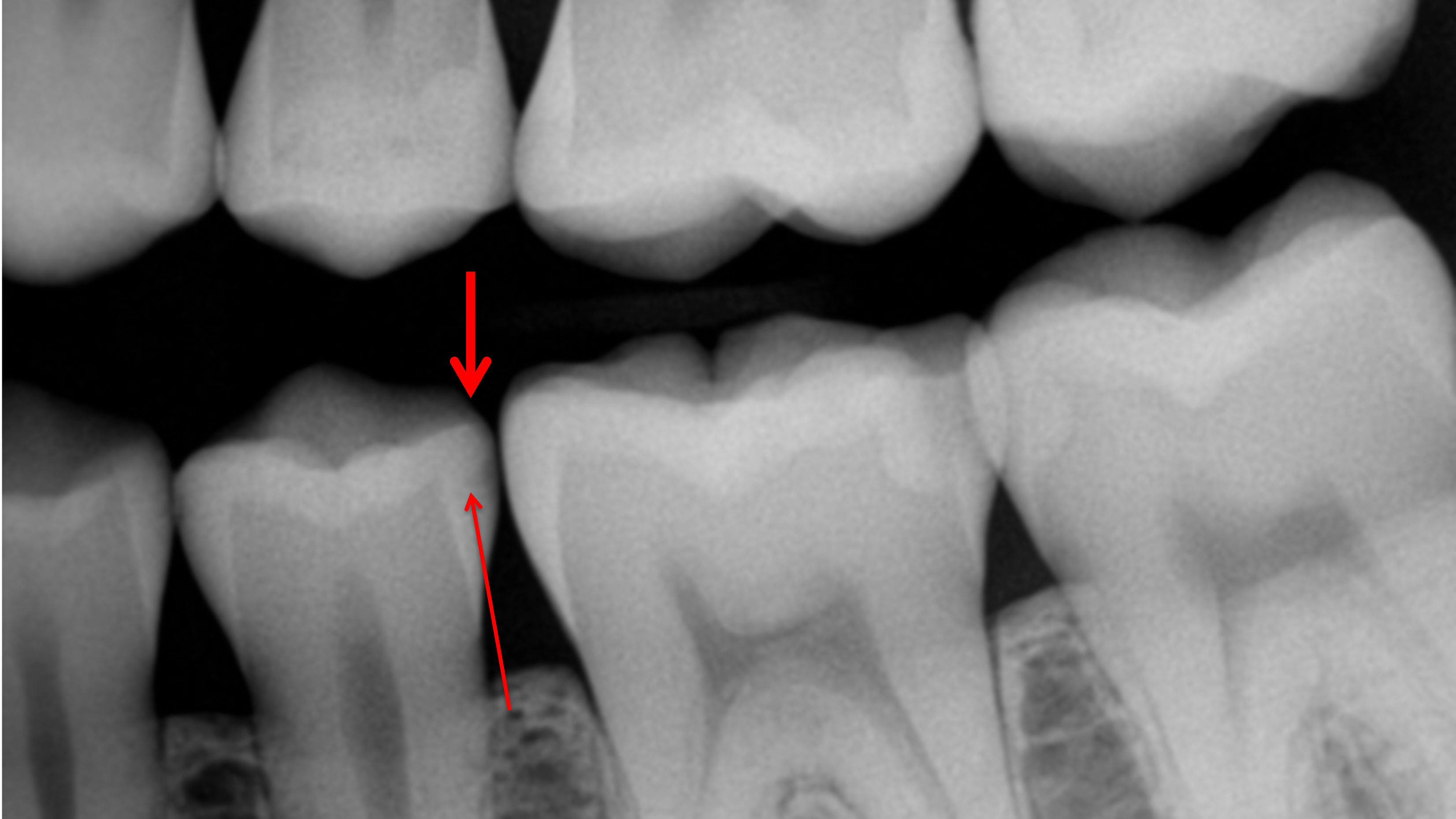 x-ray of teeth